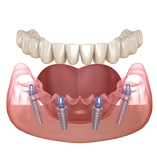 implant illustration