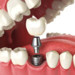 Closeup of a dental implant replacing a missing tooth in a fake mouth