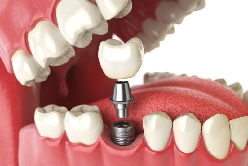 Closeup of a dental implant replacing a missing tooth in a fake mouth