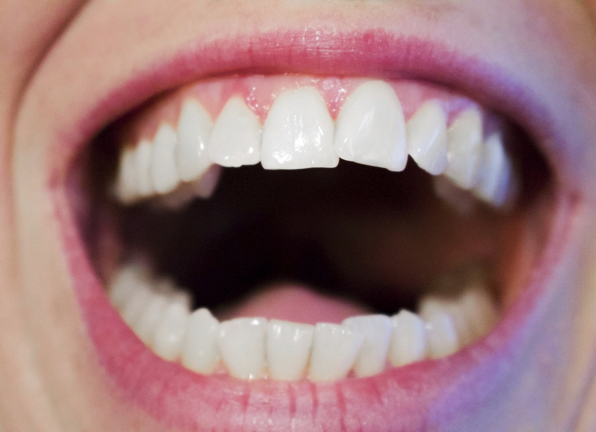 Closeup of a smile with white teeth but with some asymmetries