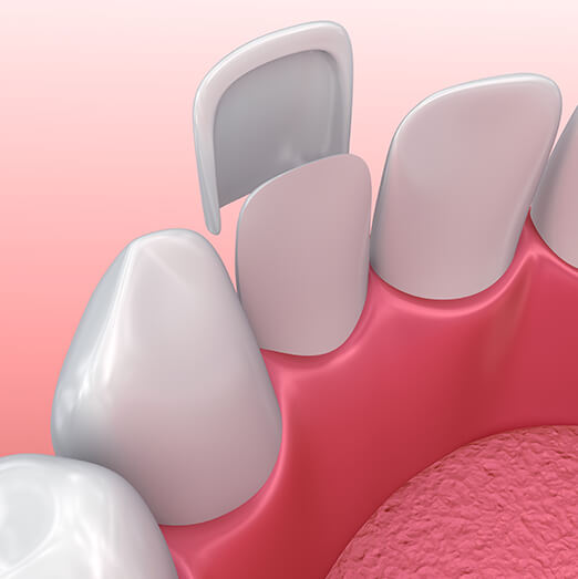 illustration of a dental veneer