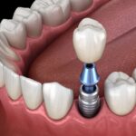 dental implant on mandibular tooth