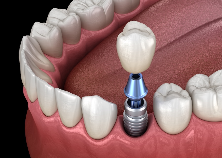 dental implant on mandibular tooth