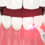 dental laser for laser gum therapy on gum disease
