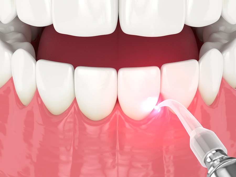 dental laser for laser gum therapy on gum disease