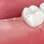 image of stitches after wisdom teeth removal