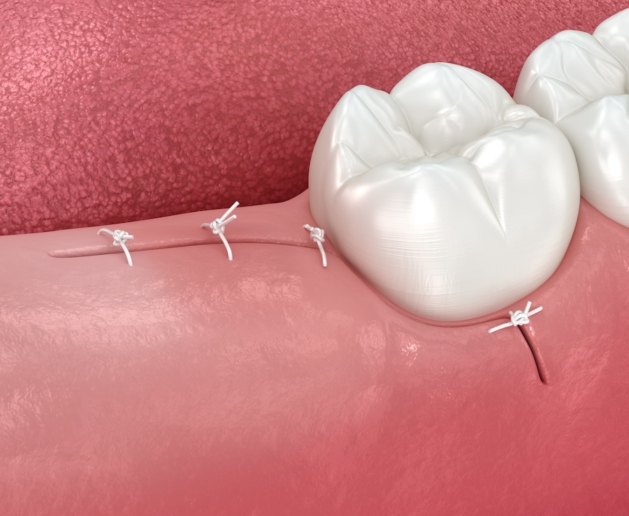 image of stitches after wisdom teeth removal