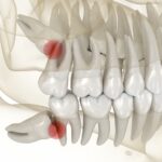 wisdom teeth causing troubles although sometimes wisdom teeth can be monitored