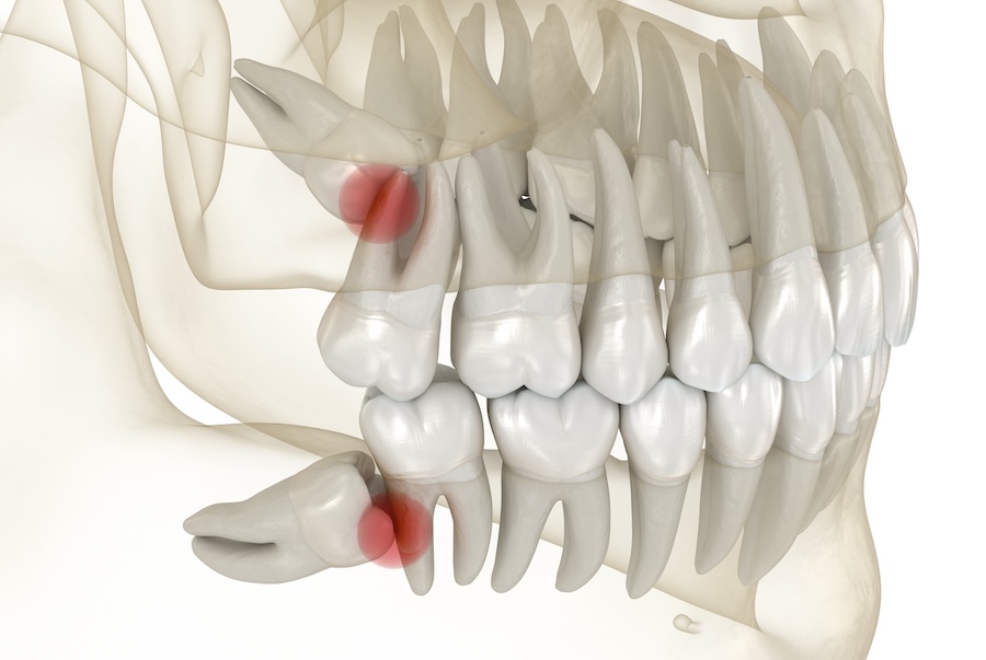 wisdom teeth causing troubles although sometimes wisdom teeth can be monitored