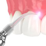 laser gum therapy for gum disease