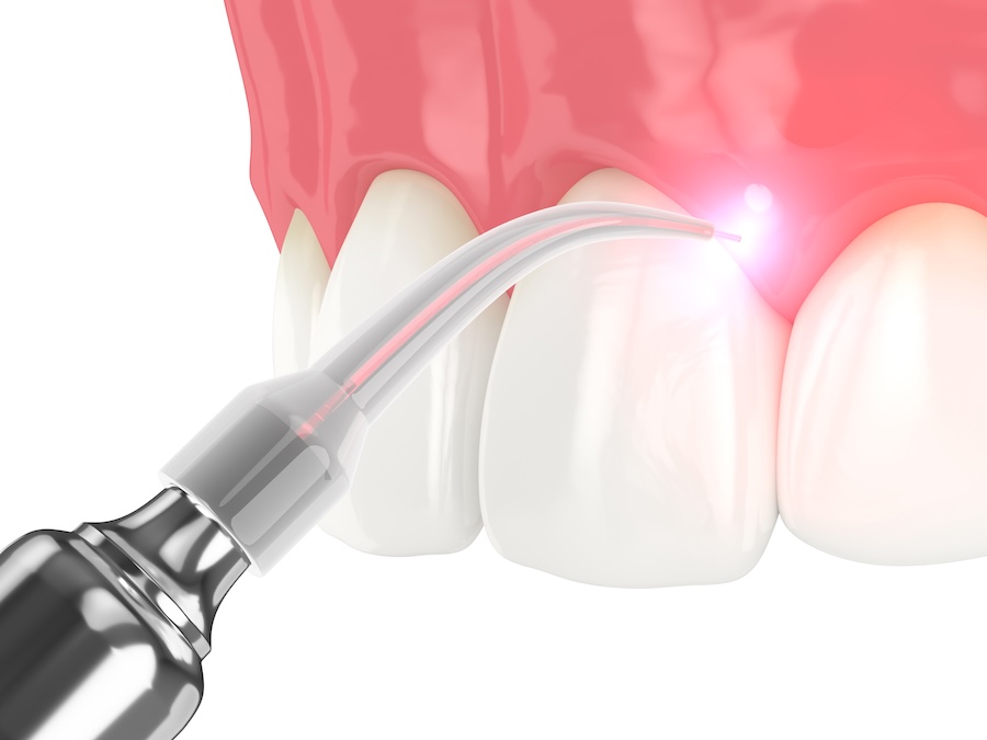 laser gum therapy for gum disease