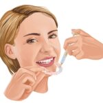 woman using custom teeth whitening aligners, kor teeth whitening